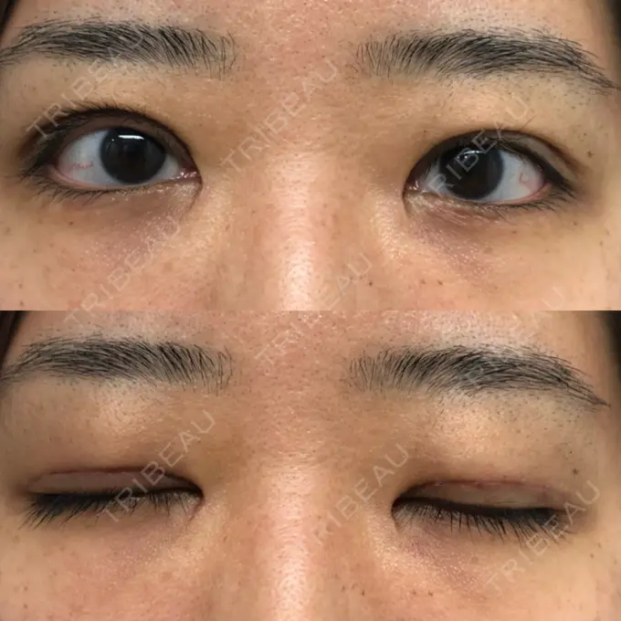 二重切開 / 目頭切開 / その他（目元） 新前橋かしま眼科形成外科クリニック DAY 14 メイン用