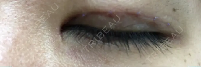 二重切開 / 目頭切開 / その他（目元） 新前橋かしま眼科形成外科クリニック DAY 14 メイン用