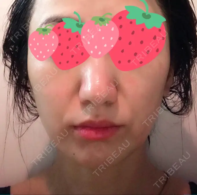 脂肪溶解注射（顔） TCB東京中央美容外科 心斎橋筋院 DAY 7 メイン用