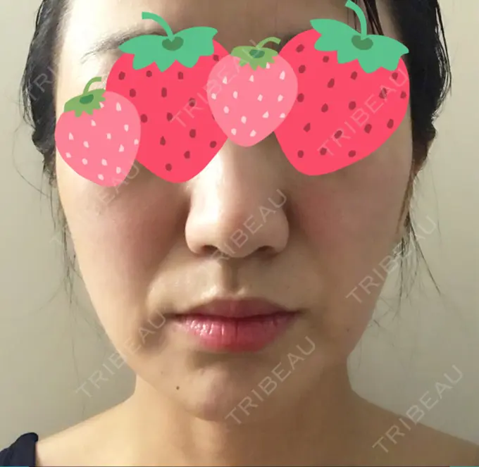 脂肪溶解注射（顔） TCB東京中央美容外科 心斎橋筋院 DAY 6 メイン用