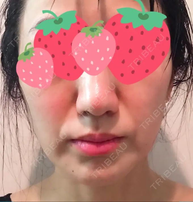 脂肪溶解注射（顔） TCB東京中央美容外科 心斎橋筋院 DAY 3 メイン用