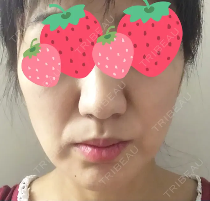 脂肪溶解注射（顔） TCB東京中央美容外科 心斎橋筋院 DAY 2 メイン用