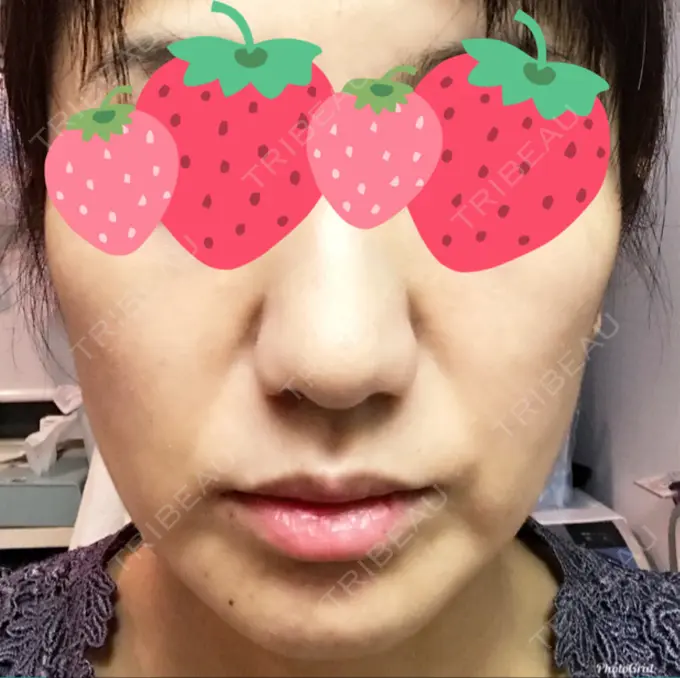 脂肪溶解注射（顔） TCB東京中央美容外科 心斎橋筋院 DAY 0 メイン用