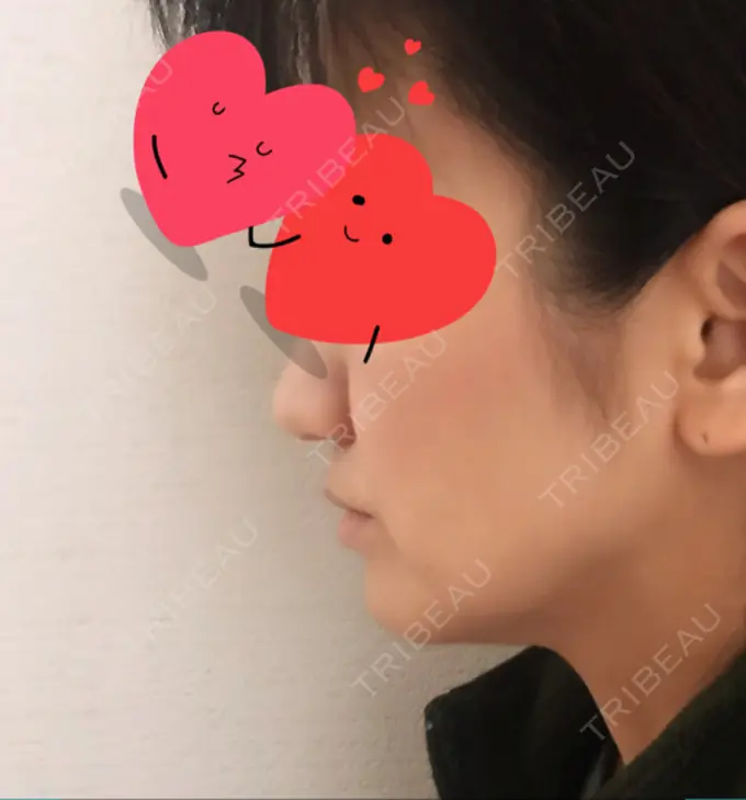 脂肪溶解注射（顔） TCB東京中央美容外科 心斎橋筋院 AFTER メイン用