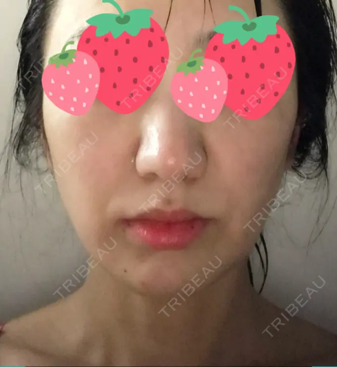 脂肪溶解注射（顔） TCB東京中央美容外科 心斎橋筋院 DAY 8 メイン用