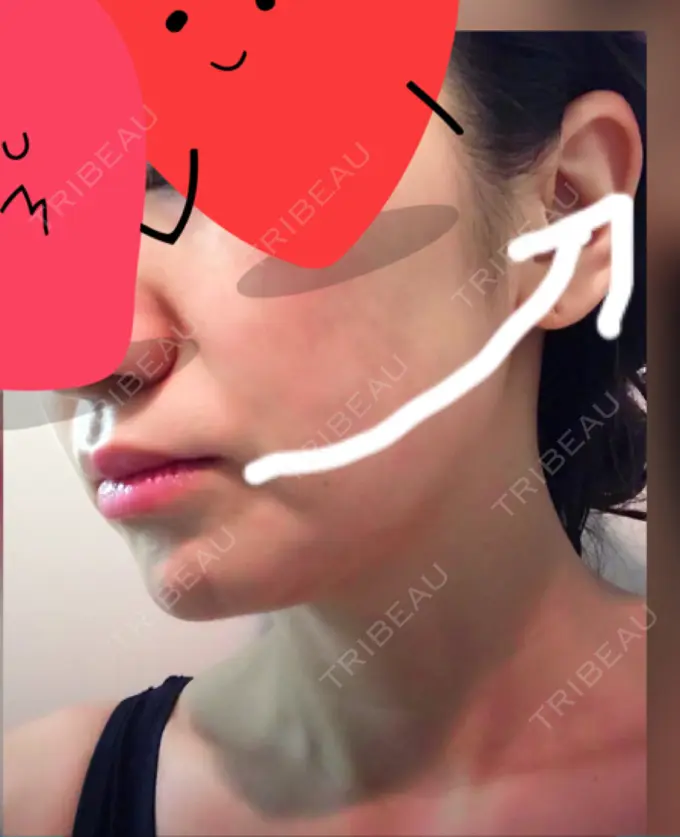 脂肪溶解注射（顔） TCB東京中央美容外科 心斎橋筋院 DAY 8 メイン用