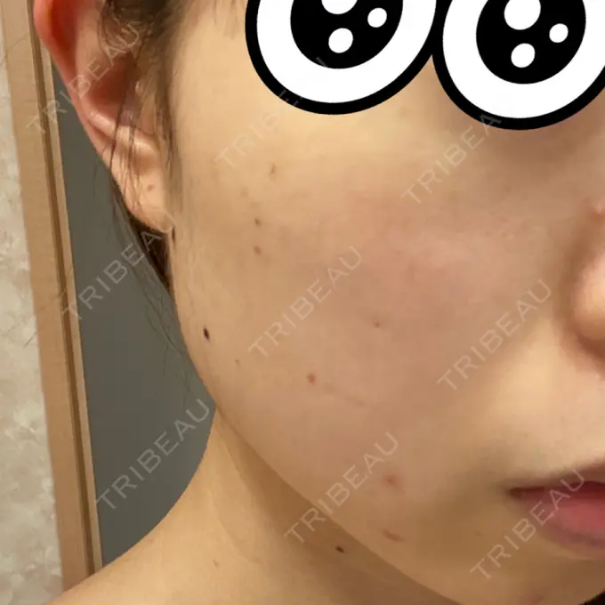 シミ取りレーザー 赤坂プレミアクリニック AFTER メイン用