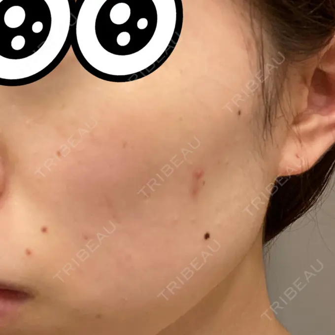 シミ取りレーザー 赤坂プレミアクリニック DAY 7 メイン用