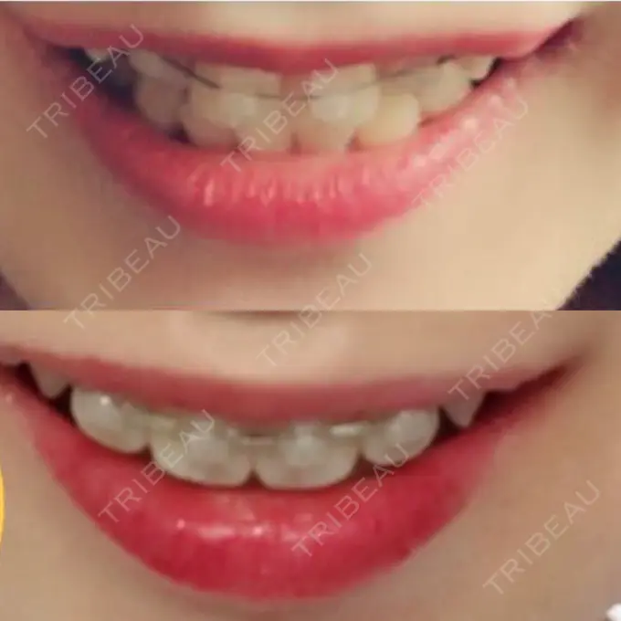 矯正（ワイヤー） 表参道ヒカリデンタル矯正歯科 DAY 101 メイン用