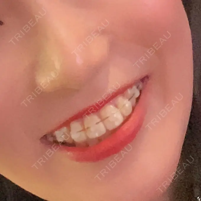 矯正（ワイヤー） 表参道ヒカリデンタル矯正歯科 DAY 730 メイン用