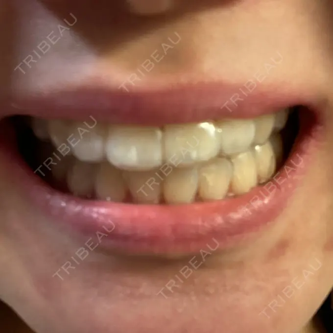 矯正（ワイヤー） 表参道ヒカリデンタル矯正歯科 AFTER メイン用