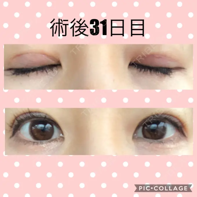 二重切開 マリアクリニック 安城院 DAY 31 メイン用