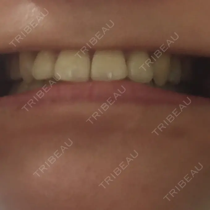 矯正（ワイヤー） 表参道ヒカリデンタル矯正歯科 DAY 861 メイン用