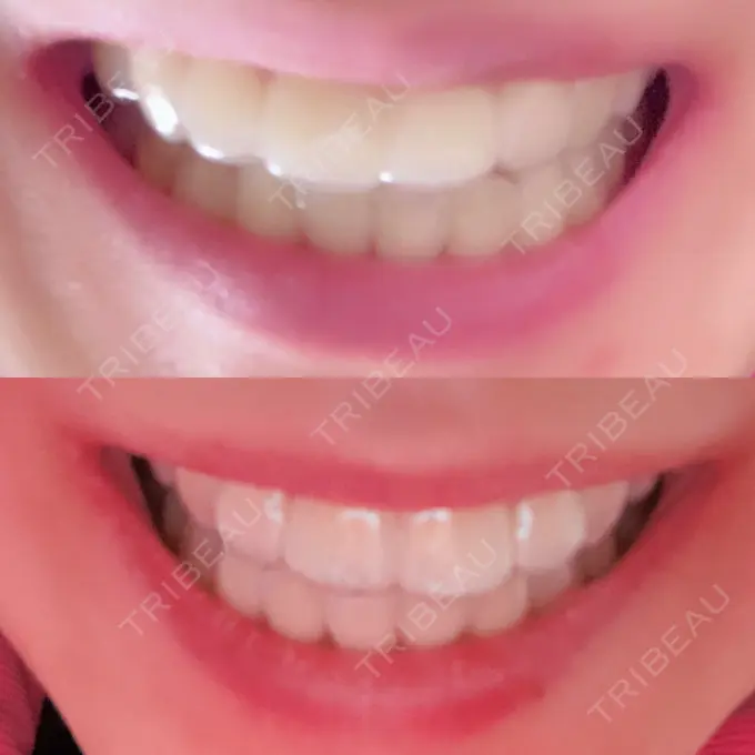 矯正（ワイヤー） 表参道ヒカリデンタル矯正歯科 DAY 861 メイン用