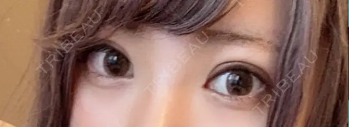 眼瞼下垂（切開） / 上まぶたの脂肪取り なでしこクリニック DAY 218 メイン用