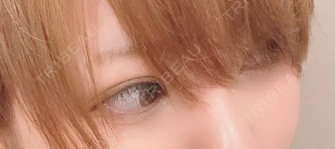 眼瞼下垂（切開） / 上まぶたの脂肪取り なでしこクリニック DAY 218 メイン用