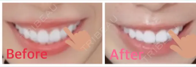 シワ取りボトックス / その他（鼻） もとび美容外科クリニック 新宿院 DAY 15 メイン用