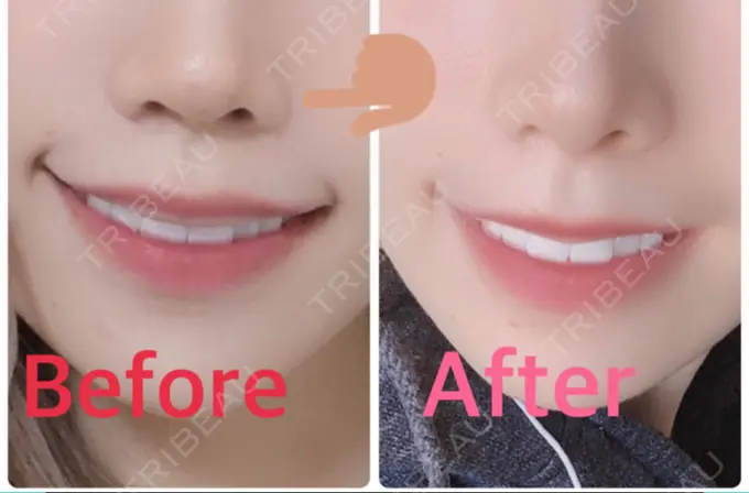 シワ取りボトックス / その他（鼻） もとび美容外科クリニック 新宿院 DAY 15 メイン用