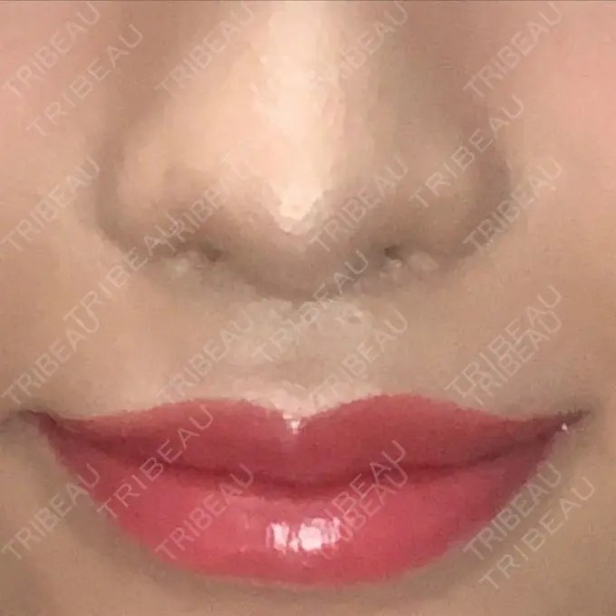 人中短縮 新宿ラクル美容外科クリニック 新宿院 DAY 62 メイン用