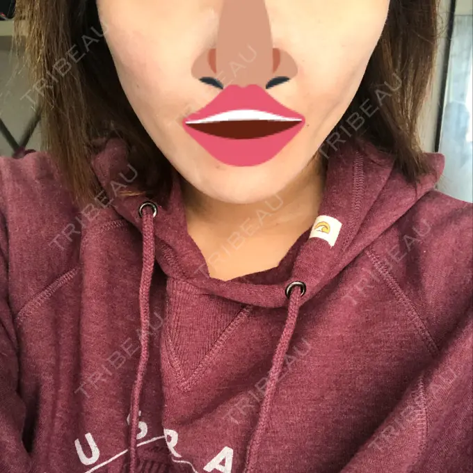 脂肪吸引（顔） アサミ美容外科 渋谷院 DAY 31 メイン用