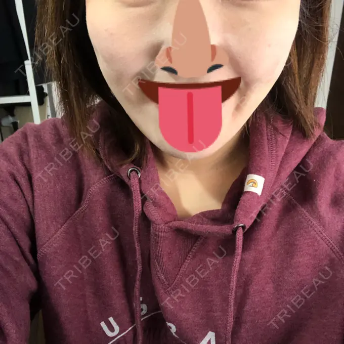 脂肪吸引（顔） アサミ美容外科 渋谷院 DAY 31 メイン用