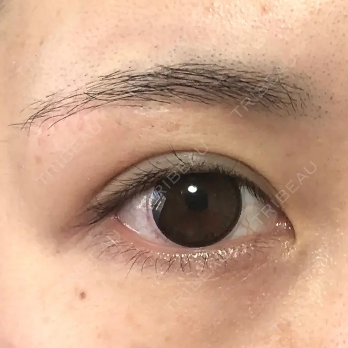 眉下切開 もとび美容外科クリニック 新宿院 DAY 185 メイン用