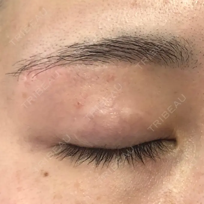 眉下切開 もとび美容外科クリニック 新宿院 DAY 185 メイン用
