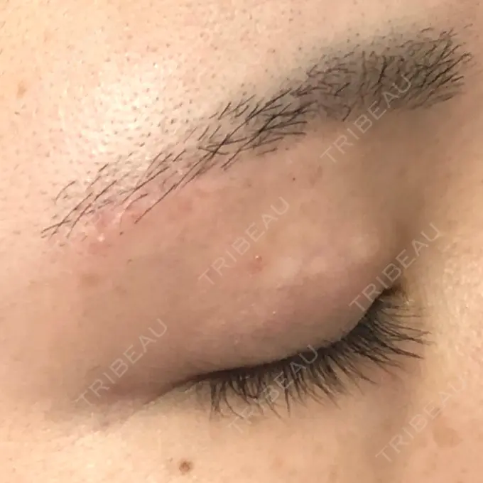 眉下切開 もとび美容外科クリニック 新宿院 DAY 185 メイン用