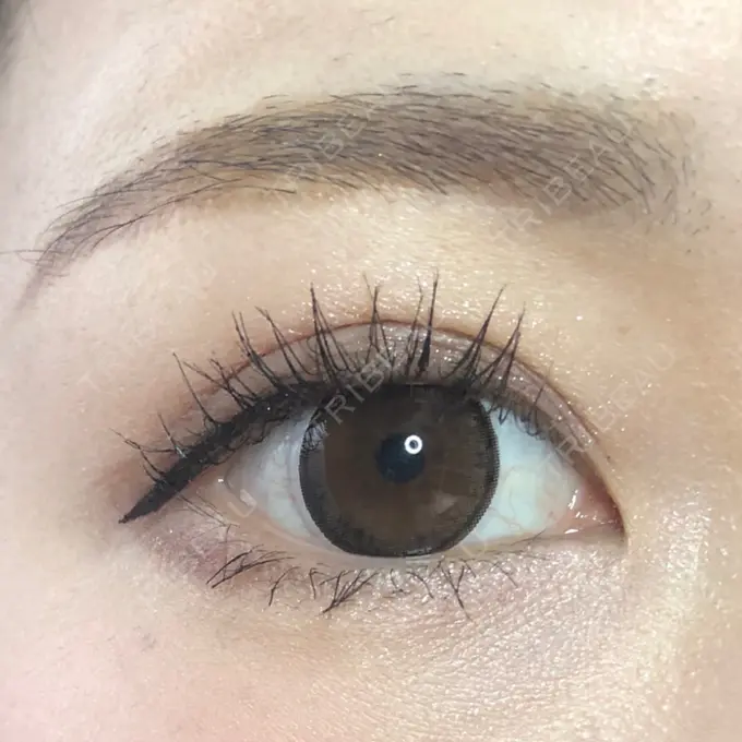 眉下切開 もとび美容外科クリニック 新宿院 DAY 190 メイン用