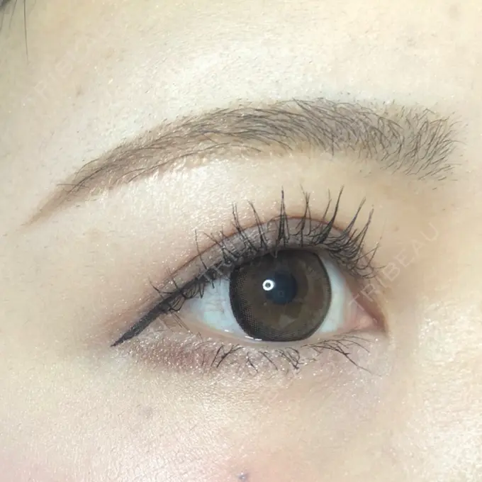 眉下切開 もとび美容外科クリニック 新宿院 DAY 190 メイン用