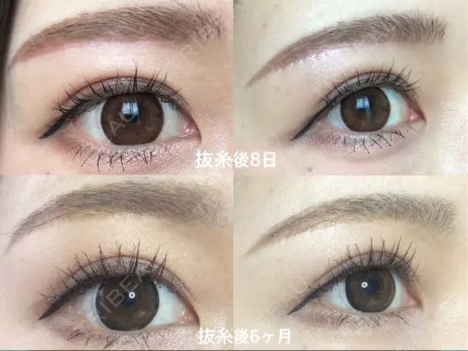 眉下切開 もとび美容外科クリニック 新宿院 DAY 190 メイン用