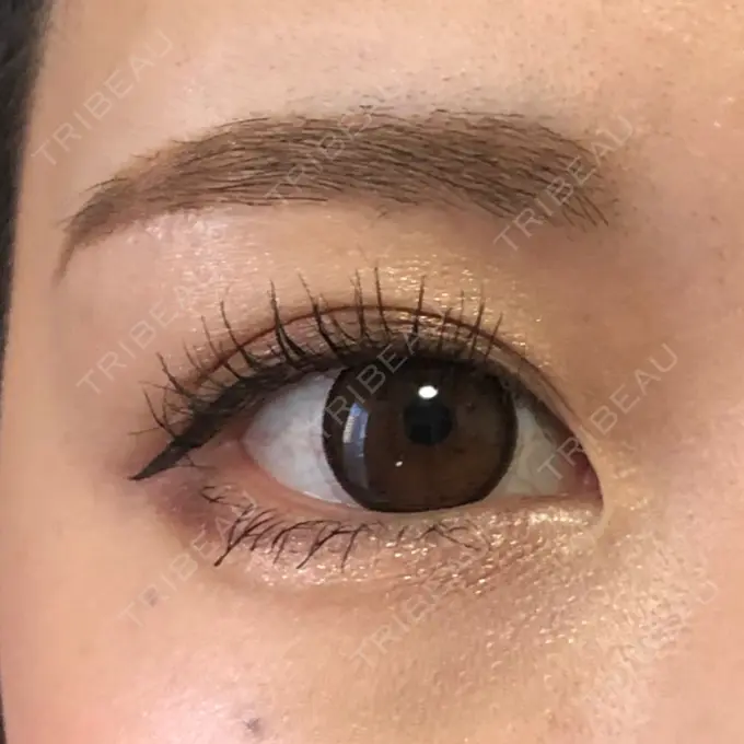 眉下切開 もとび美容外科クリニック 新宿院 AFTER メイン用