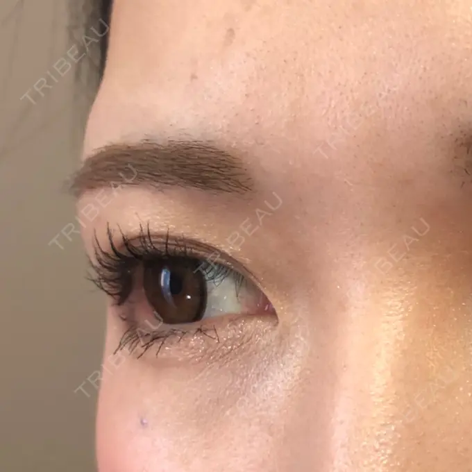 眉下切開 もとび美容外科クリニック 新宿院 DAY 209 メイン用