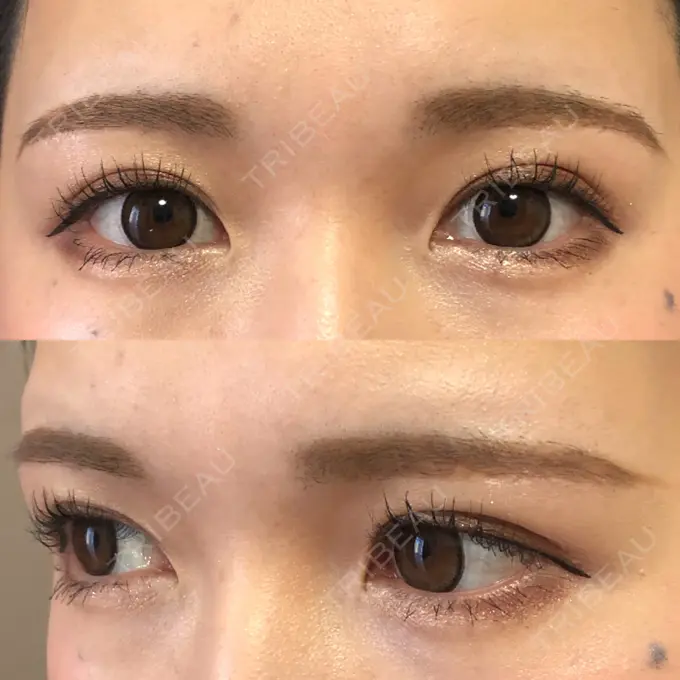 眉下切開 もとび美容外科クリニック 新宿院 DAY 209 メイン用