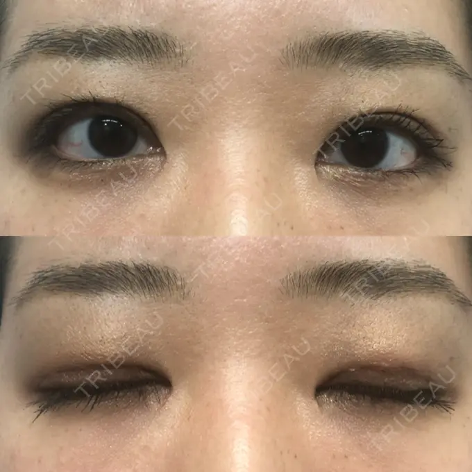 二重切開 / 目頭切開 / その他（目元） 新前橋かしま眼科形成外科クリニック DAY 19 メイン用