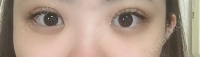 二重埋没 共立美容外科 柏院 DAY 0 メイン用