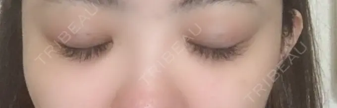 二重埋没 共立美容外科 柏院 DAY 0 メイン用