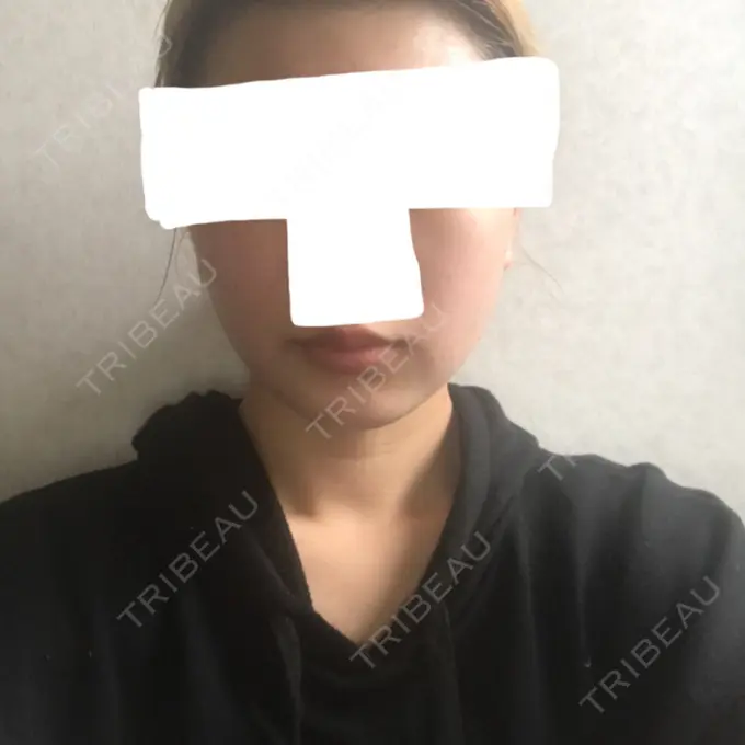 バッカルファット除去 / 脂肪吸引（顔） ジョウクリニック 大阪院 DAY 37 メイン用