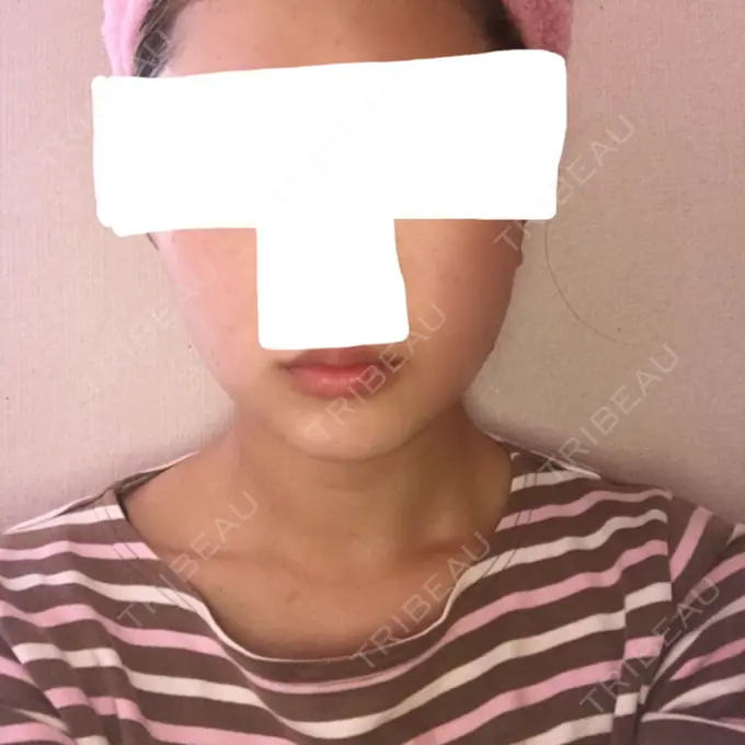 バッカルファット除去 / 脂肪吸引（顔） ジョウクリニック 大阪院 DAY 38 メイン用