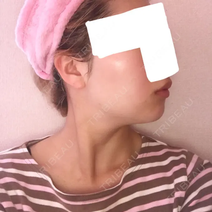 バッカルファット除去 / 脂肪吸引（顔） ジョウクリニック 大阪院 DAY 38 メイン用