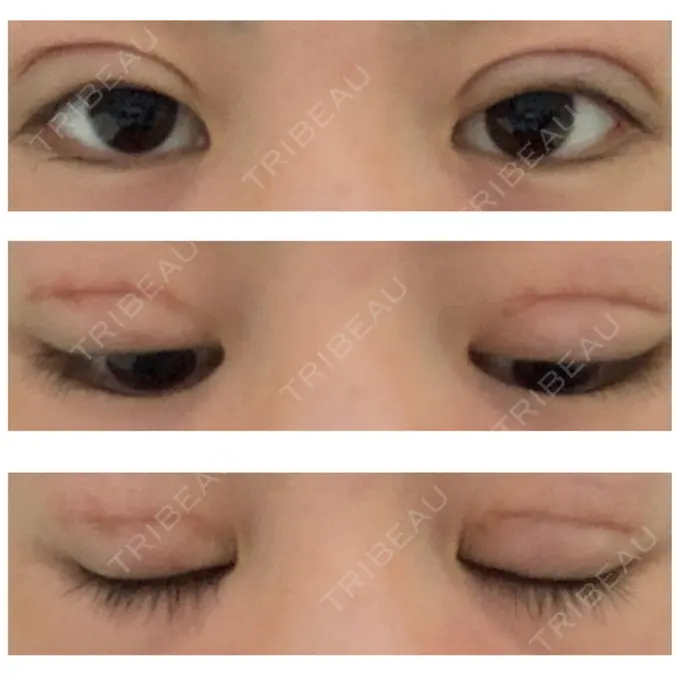 二重切開 久留米総合美容外科 DAY 36 メイン用