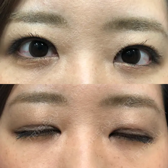 二重切開 / 目頭切開 / その他（目元） 新前橋かしま眼科形成外科クリニック DAY 20 メイン用