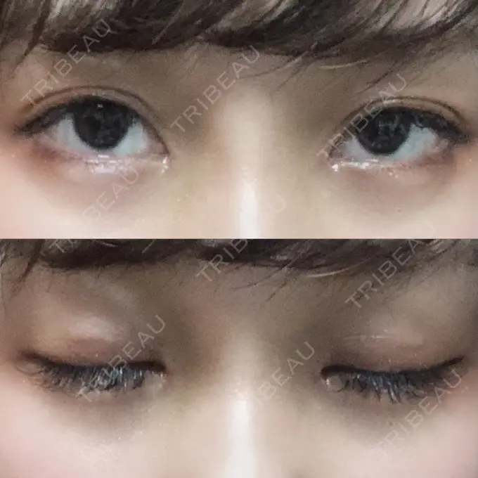 二重埋没 / 目頭切開 ドクター松井クリニック 新宿 DAY 16 メイン用