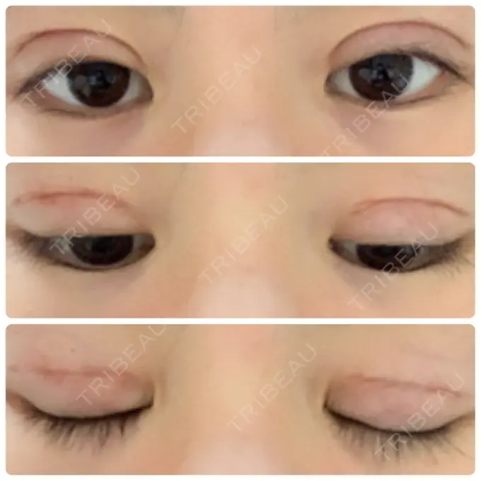 二重切開 久留米総合美容外科 DAY 37 メイン用