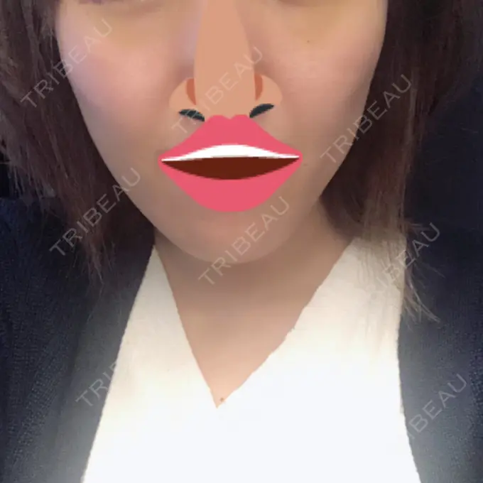 脂肪吸引（顔） アサミ美容外科 渋谷院 DAY 33 メイン用