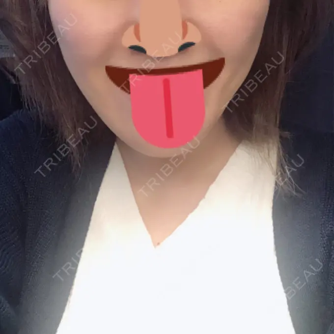 脂肪吸引（顔） アサミ美容外科 渋谷院 DAY 33 メイン用