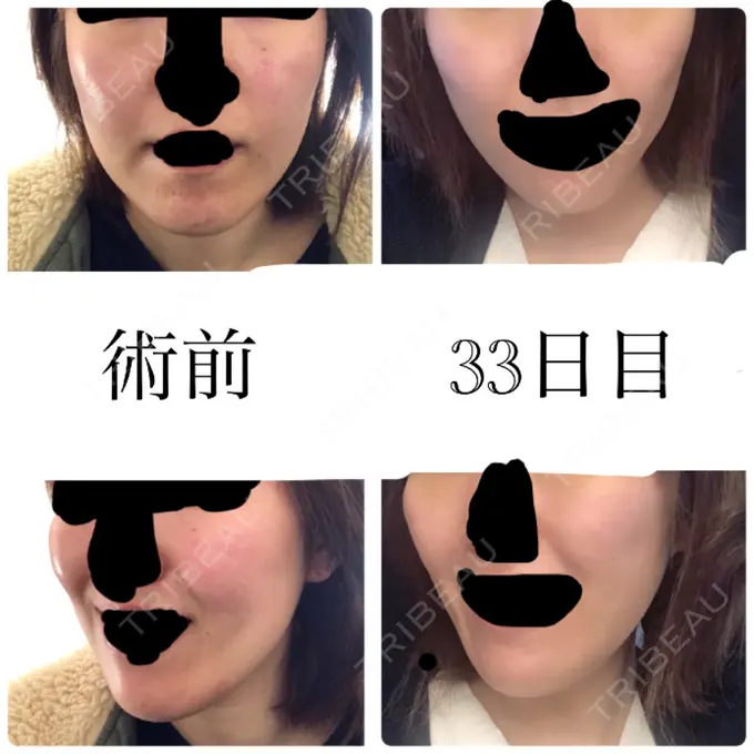 脂肪吸引（顔） アサミ美容外科 渋谷院 DAY 33 メイン用