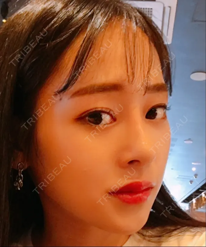 二重埋没 / 隆鼻術 / 豊胸（シリコンバッグ） MIGO（ミゴ）整形外科 DAY 31 メイン用