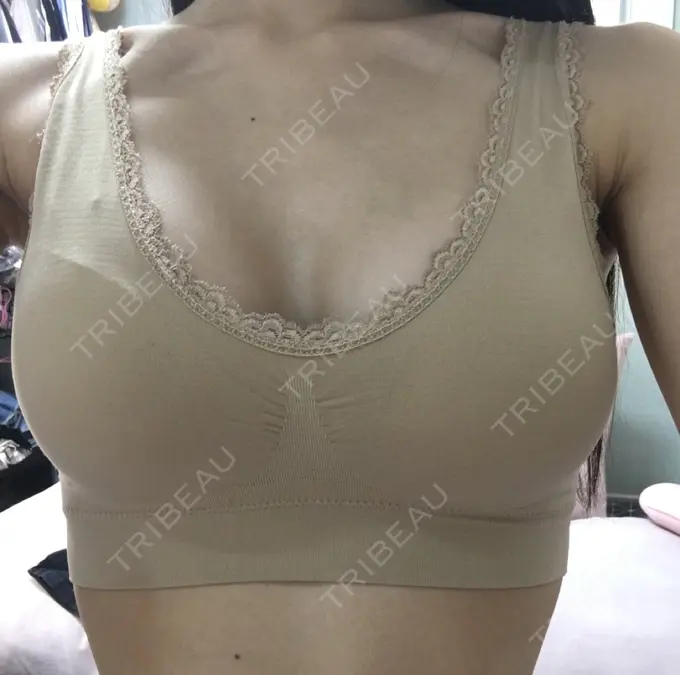 二重埋没 / 隆鼻術 / 豊胸（シリコンバッグ） MIGO（ミゴ）整形外科 DAY 31 メイン用