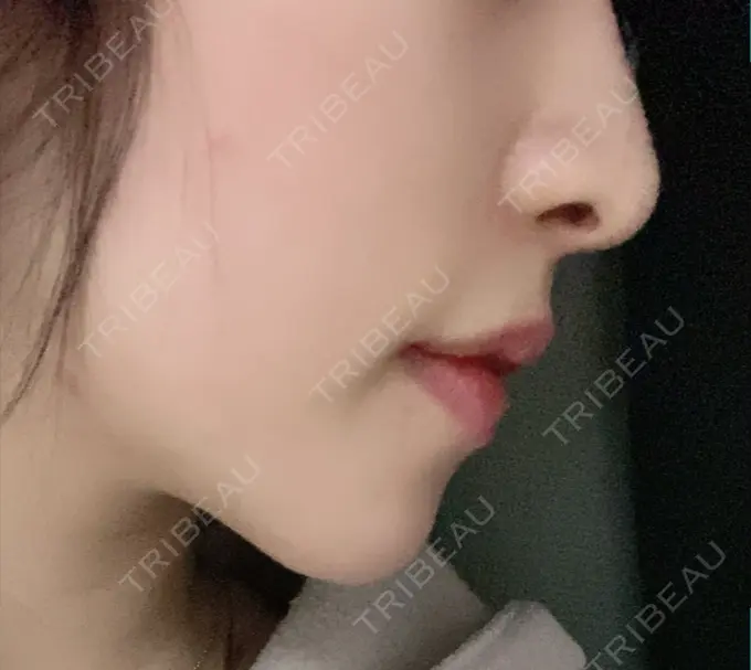 あごプロテーゼ / 骨切り（あご） / 脂肪吸引（顔） 心斎橋コムロ美容外科クリニック DAY 99 メイン用